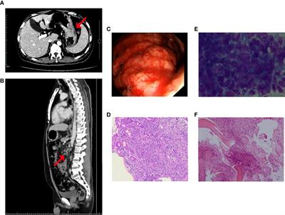 Case Report: Prompt Response to Savolitinib in a Case of Advanced Gastric Cancer With Bone Marrow Invasion and MET Abnormalities